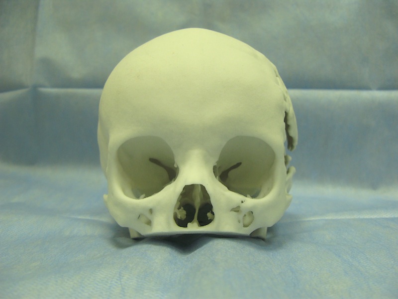Краниопластика: применение 3D-печати для пластики черепа