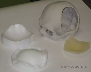 CAD-моделей по данным КТ и МРТ, 3D-печать, краниопластика