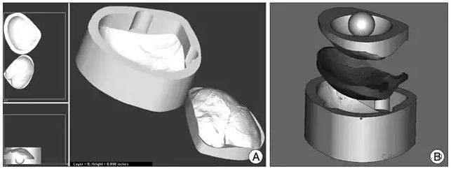 CAD-моделей по данным КТ и МРТ, 3D-печать, краниопластика 