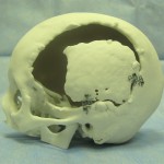 3D-печать, краниопластика, пластика черепа
