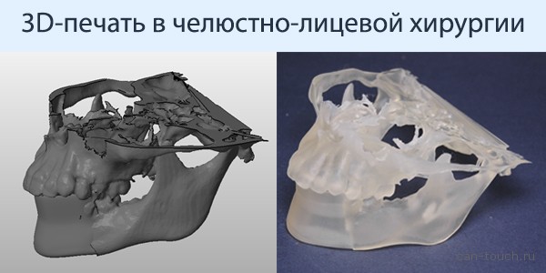 3D-печать, медицина